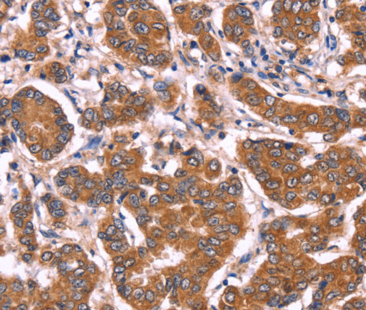 Immunohistochemistry of paraffin-embedded Human breast cancer tissue using COL20A1 Polyclonal Antibody at dilution 1:40