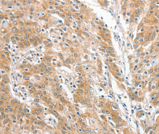 Immunohistochemistry of paraffin-embedded Human gastric cancer using COL4A3BP Polyclonal Antibody at dilution of 1:60