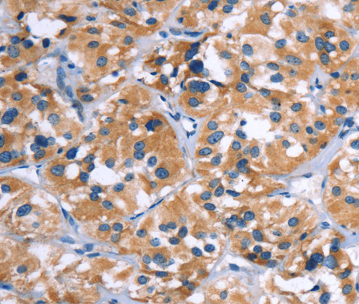 Immunohistochemistry of paraffin-embedded Human thyroid cancer using COMP Polyclonal Antibody at dilution of 1:50
