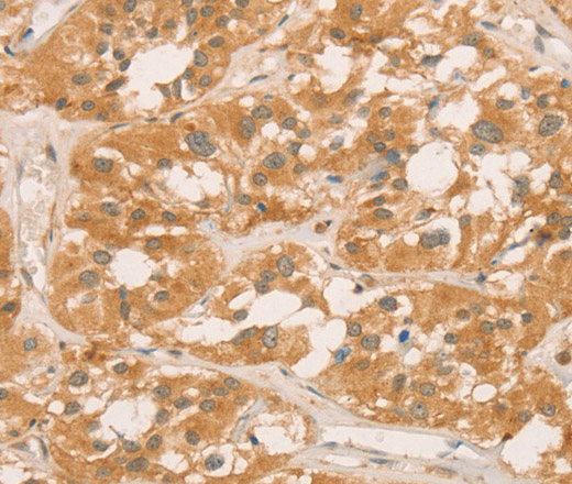 Immunohistochemistry of paraffin-embedded Human thyroid cancer tissue using CPB1 Polyclonal Antibody at dilution of 1:60