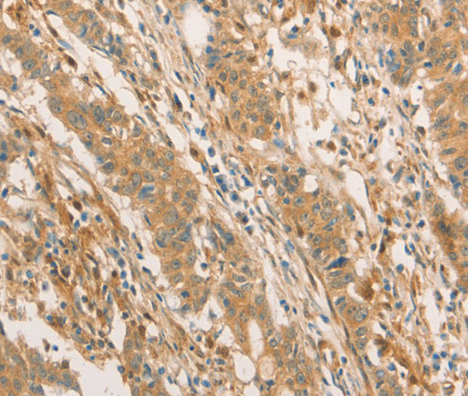 Immunohistochemistry of paraffin-embedded Human gastric cancer using CPB1 Polyclonal Antibody at dilution of 1:60