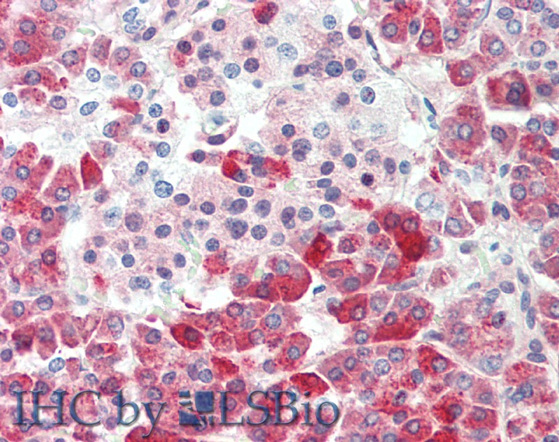 Immunohistochemistry of paraffin-embedded Human gastric cancer using CPB1 Polyclonal Antibody at dilution of 1:60.