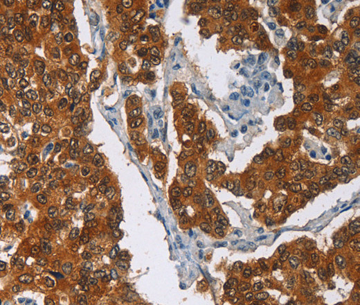 Immunohistochemistry of paraffin-embedded Human breast cancer tissue using CRABP2 Polyclonal Antibody at dilution 1:40