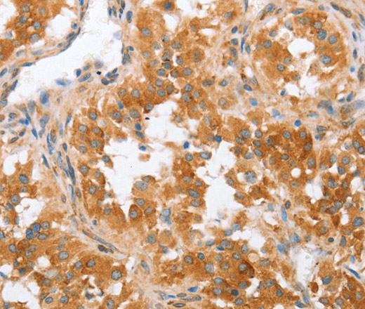 Immunohistochemistry of paraffin-embedded Human thyroid cancer using CRELD2 Polyclonal Antibody at dilution of 1:50