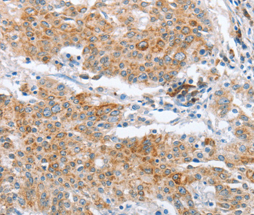 Immunohistochemistry of paraffin-embedded Human gastric cancer using CRELD2 Polyclonal Antibody at dilution of 1:50