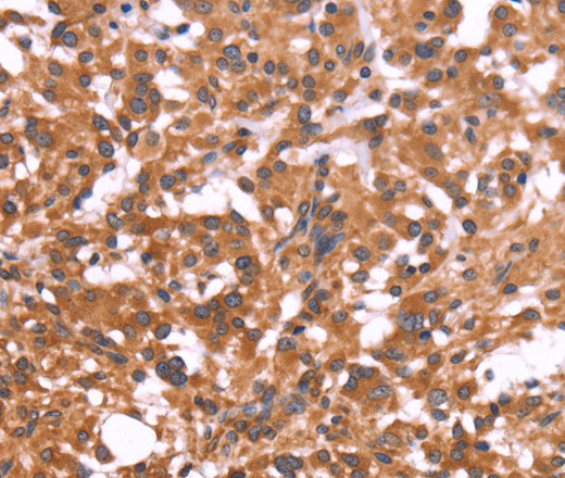 Immunohistochemistry of paraffin-embedded Human thyroid cancer tissue using CRISP3 Polyclonal Antibody at dilution 1:50