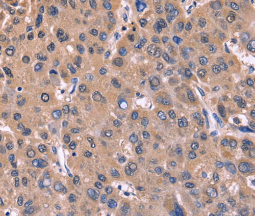 Immunohistochemistry of paraffin-embedded Human liver cancer tissue using CSNK1D Polyclonal Antibody at dilution 1:50