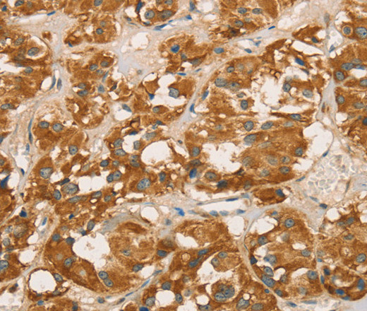 Immunohistochemistry of paraffin-embedded Human thyroid cancer tissue using RBBP8 Polyclonal Antibody at dilution 1:65