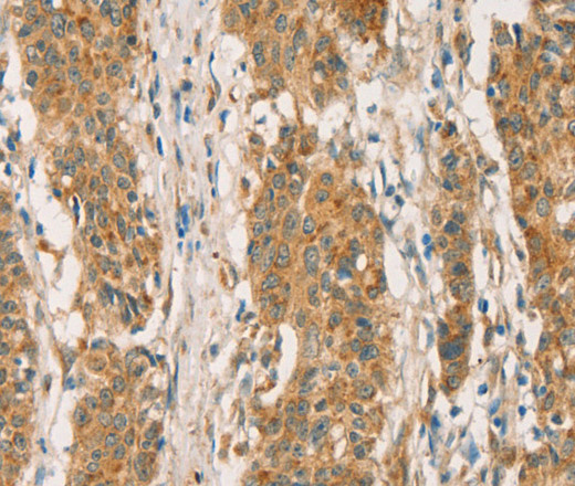 Immunohistochemistry of paraffin-embedded Human gastric cancer tissue using RBBP8 Polyclonal Antibody at dilution 1:65