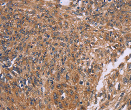 Immunohistochemistry of paraffin-embedded Human ovarian cancer tissue using CTNNBL1 Polyclonal Antibody at dilution 1:50