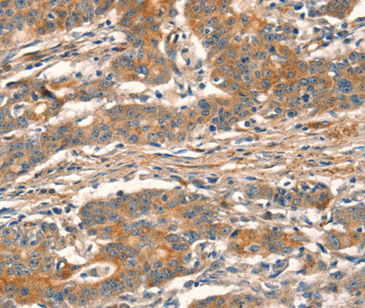 Immunohistochemistry of paraffin-embedded Human gasrtic cancer tissue using CUEDC2 Polyclonal Antibody at dilution 1:30