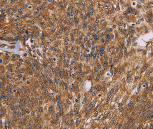 Immunohistochemistry of paraffin-embedded Human ovarian cancer using PPIB Polyclonal Antibody at dilution of 1:45