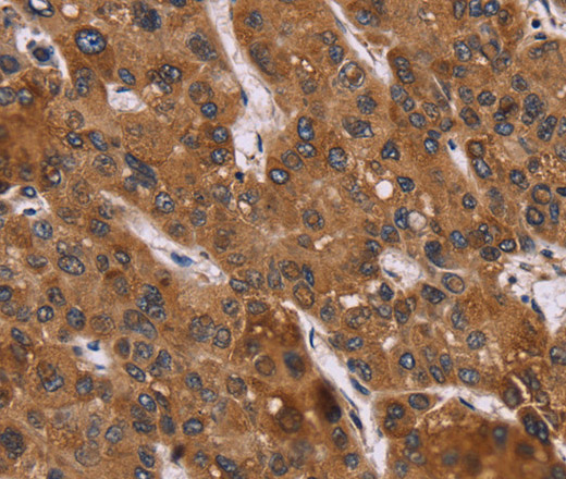 Immunohistochemistry of paraffin-embedded Human liver cancer using PPIB Polyclonal Antibody at dilution of 1:45