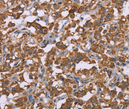 Immunohistochemistry of paraffin-embedded Human thyroid cancer using Cyclophilin F Polyclonal Antibody at dilution of 1:45