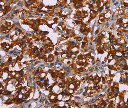 Immunohistochemistry of paraffin-embedded Human thyroid cancer tissue using CYP2W1 Polyclonal Antibody at dilution 1:60