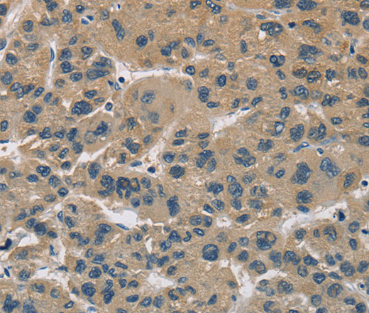 Immunohistochemistry of paraffin-embedded Human liver cancer using CYR61 Polyclonal Antibody at dilution of 1:60