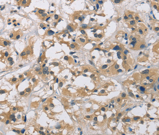 Immunohistochemistry of paraffin-embedded Human thyroid cancer using CYR61 Polyclonal Antibody at dilution of 1:60