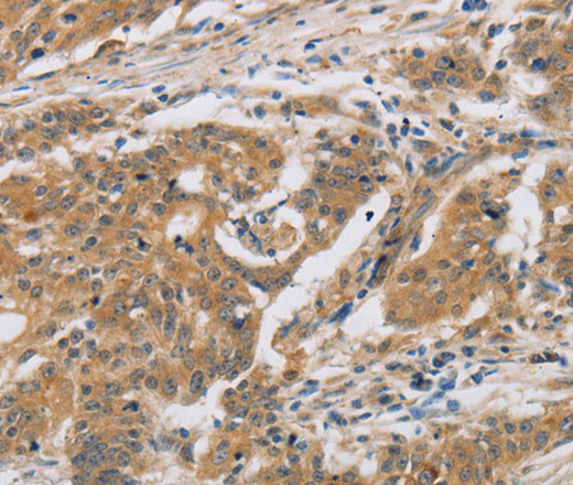 Immunohistochemistry of paraffin-embedded Human ovarian cancer tissue using CST6 Polyclonal Antibody at dilution 1:30