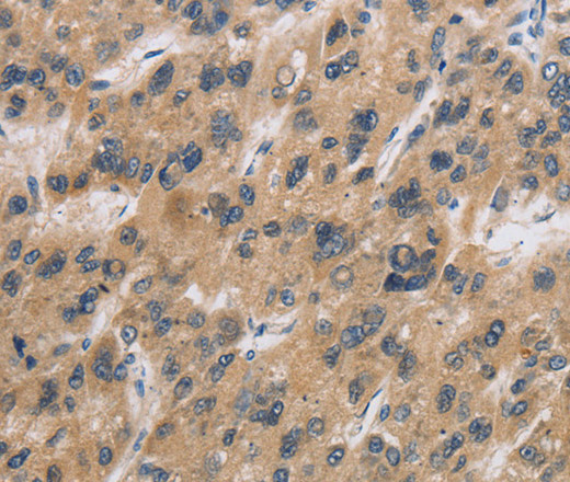 Immunohistochemistry of paraffin-embedded Human liver cancer tissue using CST6 Polyclonal Antibody at dilution 1:30