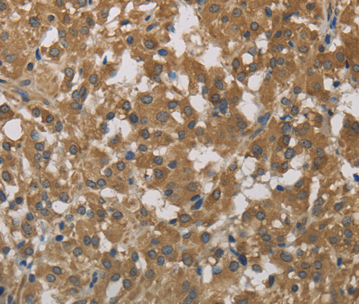 Immunohistochemistry of paraffin-embedded Human thyroid cancer using Cytochrome b5 Polyclonal Antibody at dilution of 1:40