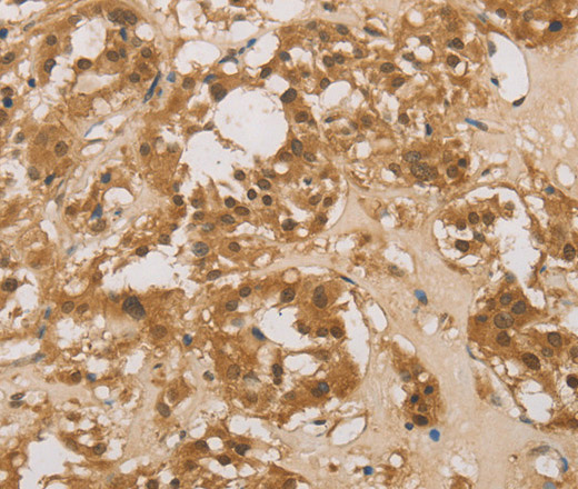 Immunohistochemistry of paraffin-embedded Human thyroid cancer tissue using DACH1 Polyclonal Antibody at dilution 1:50