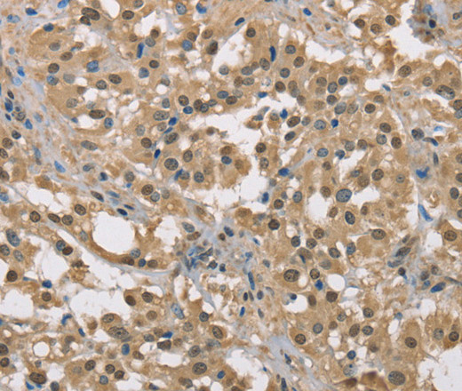 Immunohistochemistry of paraffin-embedded Human thyroid cancer tissue using DACH2 Polyclonal Antibody at dilution 1:40