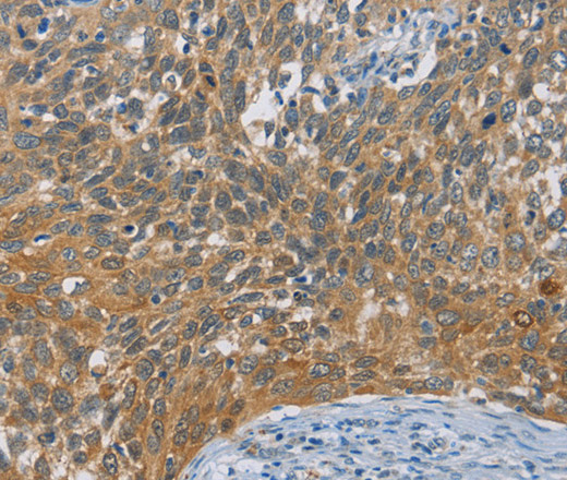 Immunohistochemistry of paraffin-embedded Human cervical cancer tissue using DIO1 Polyclonal Antibody at dilution 1:60