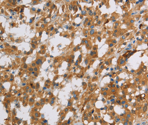 Immunohistochemistry of paraffin-embedded Human thyroid cancer using DBH Polyclonal Antibody at dilution of 1:70