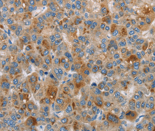 Immunohistochemistry of paraffin-embedded Human liver cancer using DBH Polyclonal Antibody at dilution of 1:70