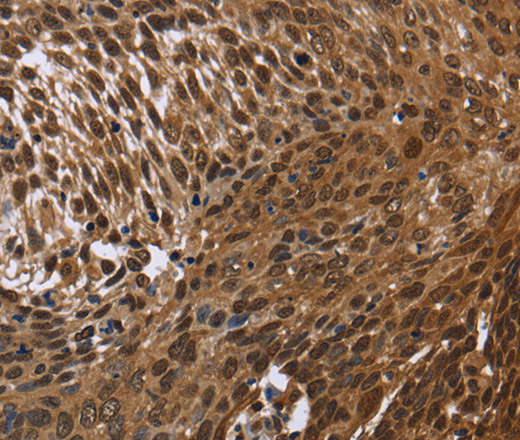 Immunohistochemistry of paraffin-embedded Human cervical cancer tissue using DCP1A Polyclonal Antibody at dilution 1:50