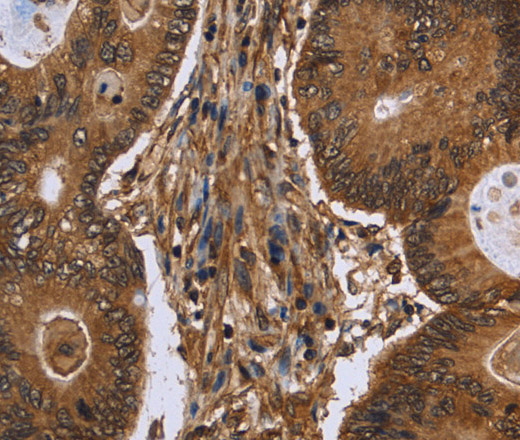 Immunohistochemistry of paraffin-embedded Human colon cancer tissue using DCP1A Polyclonal Antibody at dilution 1:50