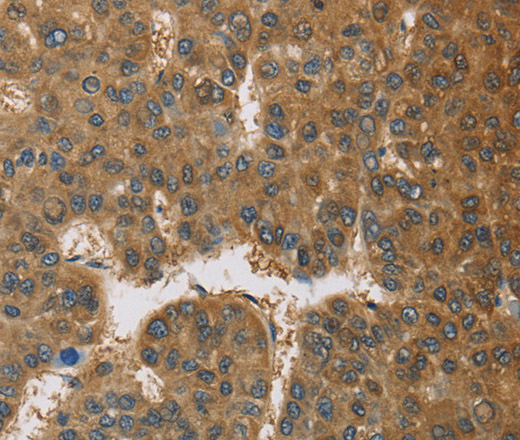 Immunohistochemistry of paraffin-embedded Human liver cancer tissue using TNFRSF10D Polyclonal Antibody at dilution 1:60