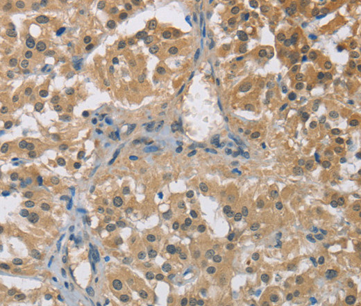 Immunohistochemistry of paraffin-embedded Human thyroid cancer tissue using TNFRSF10D Polyclonal Antibody at dilution 1:60