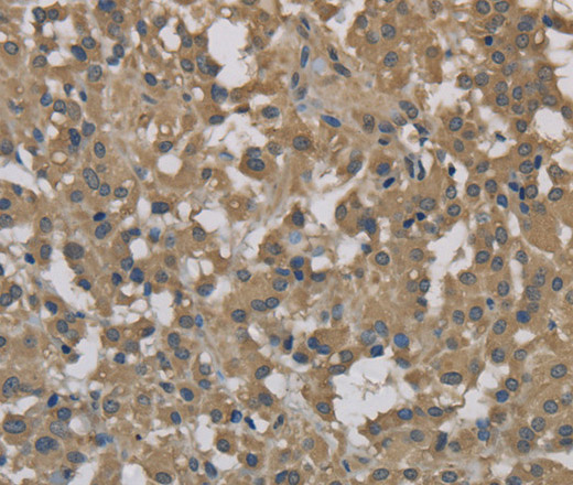 Immunohistochemistry of paraffin-embedded Human thyroid cancer tissue using DCTN3 Polyclonal Antibody at dilution 1:70