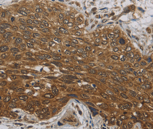 Immunohistochemistry of paraffin-embedded Human cervical cancer tissue using DCTN3 Polyclonal Antibody at dilution 1:70