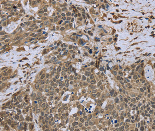 Immunohistochemistry of paraffin-embedded Human cervical cancer tissue using DCTN4 Polyclonal Antibody at dilution 1:50