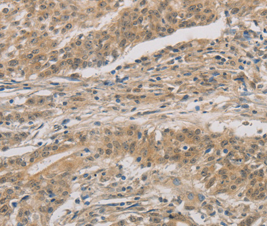 Immunohistochemistry of paraffin-embedded Human gastric cancer tissue using DDIT4 Polyclonal Antibody at dilution 1:30