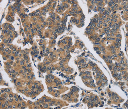 Immunohistochemistry of paraffin-embedded Human breast cancer using DHRS3 Polyclonal Antibody at dilution of 1:30