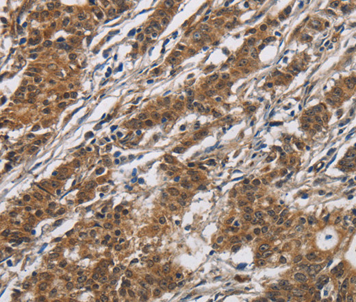 Immunohistochemistry of paraffin-embedded Human gastric cancer using DHRS3 Polyclonal Antibody at dilution of 1:30