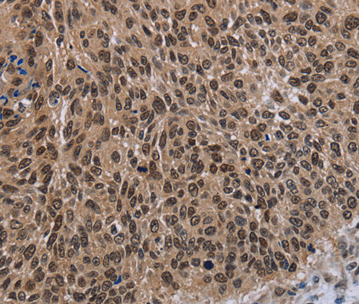 Immunohistochemistry of paraffin-embedded Human lung cancer tissue using DLX4 Polyclonal Antibody at dilution 1:50