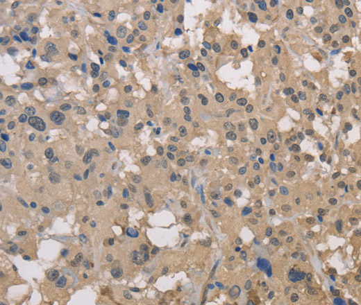 Immunohistochemistry of paraffin-embedded Human thyroid cancer using DRG1 Polyclonal Antibody at dilution of 1:30