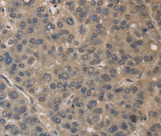 Immunohistochemistry of paraffin-embedded Human liver cancer using DRG1 Polyclonal Antibody at dilution of 1:30