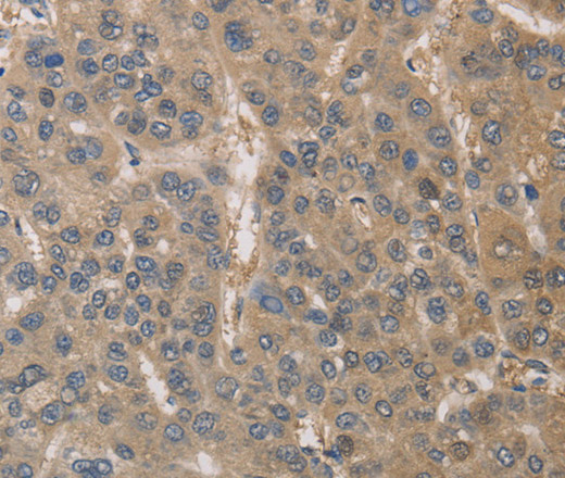 Immunohistochemistry of paraffin-embedded Human liver cancer using DPYSL3 Polyclonal Antibody at dilution of 1:30