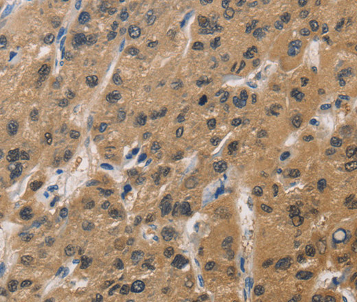 Immunohistochemistry of paraffin-embedded Human liver cancer tissue using DUSP26 Polyclonal Antibody at dilution 1:60