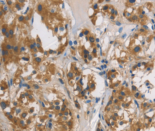 Immunohistochemistry of paraffin-embedded Human thyroid cancer tissue using DUSP26 Polyclonal Antibody at dilution 1:60