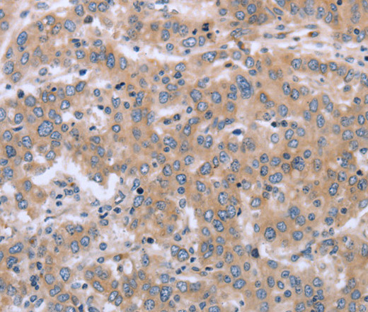 Immunohistochemistry of paraffin-embedded Human liver cancer using MAPRE3 Polyclonal Antibody at dilution of 1:30