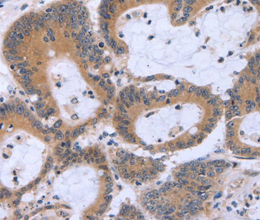 Immunohistochemistry of paraffin-embedded Human colon cancer using MAPRE3 Polyclonal Antibody at dilution of 1:30