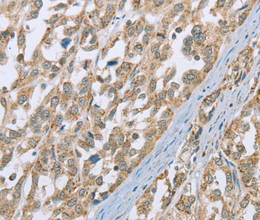 Immunohistochemistry of paraffin-embedded Human esophagus cancer using ECHS1 Polyclonal Antibody at dilution of 1:35