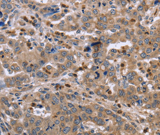 Immunohistochemistry of paraffin-embedded Human liver cancer tissue using EDA Polyclonal Antibody at dilution 1:30