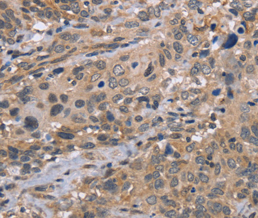 Immunohistochemistry of paraffin-embedded Human cervical cancer tissue using EDA Polyclonal Antibody at dilution 1:30
